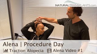 African American Female Traction  Edges Hair Transplant  Dr Kevin Blumenthal Alena [upl. by Fayth534]