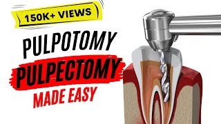 Pulpotomy and Pulpectomy  PEDIATRIC DENTISTRY [upl. by Sucramel911]