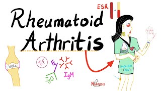 RHEUMATOID ARTHRITIS DIAGNOSIS CRITERIATREATMENT NURSING MANAGEMENT RHEUMATOLOGY MEDICINE LECTURES [upl. by Abert]