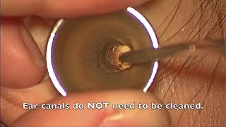 Dr Sears’ Live Ear Wax Removal [upl. by Eidok]