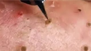 Full Giant Blackheads Popping Video Blackheads Removal 2019 [upl. by Lizette]