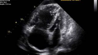 Pulmonary Hypertension echo [upl. by Davidde487]