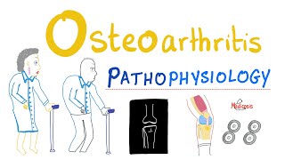 Osteoarthritis OA  Pathophysiology  Rheumatology Series [upl. by Macintyre65]