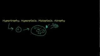 Cellular Adaptation  Atrophy Hypertrophy Hyperplasia Dysplasia Metaplasia [upl. by Swanson]