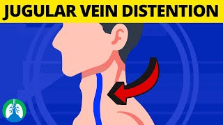 What is Jugular Venous Distention Medical Definition and Explanation [upl. by Yartnod]