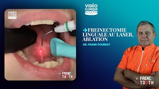 Freinectomie linguale au laser Ablation  Dr Pourrat [upl. by Mij]