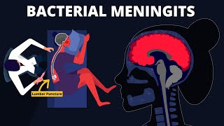 Bacterial Meningitis  Symptoms Diagnosis Treatments amp Pathology [upl. by Ledniahs613]