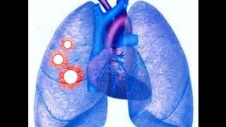 Approach to Pulmonary Nodules 04142017 [upl. by Airdnat]