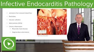 Infective Endocarditis IE Pathology – Infectious Diseases  Lecturio [upl. by Peck]