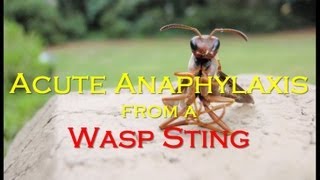 Anaphylactic Shock First Aid How To Use Epipen [upl. by Wilinski519]