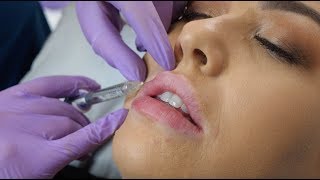 Lip Fillers  what to expect during the procedure  The Laser amp Skin Clinic [upl. by Nahgen]