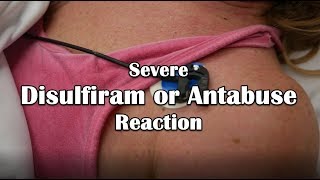 Disulfiram or Antabuse Reaction Emergency [upl. by Pompei579]