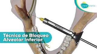 Técnica de bloqueo alveolar inferior 💉 🦷  New Stetic SA [upl. by Rachel]