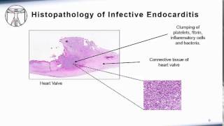 Endocarditis Pathophysiology [upl. by Jutta222]