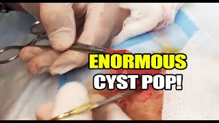 Enormous Cyst Removal Dr Gilmores Biggest Cysts [upl. by Kalila]