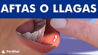 LLAGAS EN LA BOCA – Cómo curar las aftas bucales © [upl. by Enalahs]