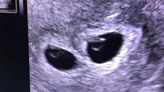 Sonogram Twins at 5 weeks [upl. by Cayser]