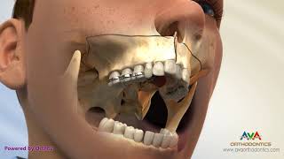 Surgical Orthodontic Treatment for Constricted Upper Jaw  SARPE [upl. by Allekim]