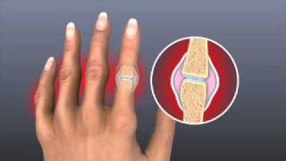 Rheumatoid Arthritis  Treatment  Johns Hopkins [upl. by Ahras]