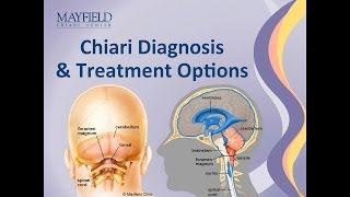 Chiari Malformation Diagnosis amp Treatment Options [upl. by Sharity]