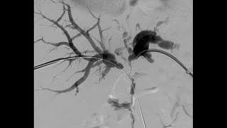 Surgical Drain Drain Tube Types Uses Complications [upl. by Ardnoek782]