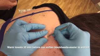 Blackheads back removal  the Australian Anaconda [upl. by Renard]