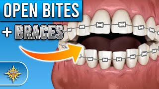 How Do Braces Fix Open Bites  Premier Orthodontics [upl. by Old]