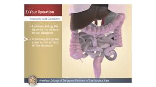 Percutaneous cholecystostomy amp interval cholecystectomy [upl. by Adleme268]