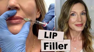 My Experience Getting Lip Filler for Vertical Wrinkles [upl. by Hendel]