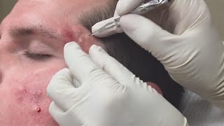 Super Satisfying Blackhead Removal [upl. by Tiemroth]