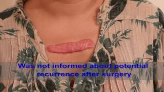 Chest Keloids  Mistakes to Avoid [upl. by Marian]