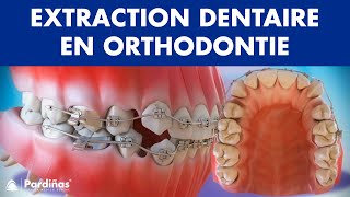 Extraction dentaire en orthodontie © [upl. by Rap]