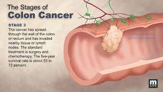 Stages of Colon Cancer [upl. by Klemperer657]