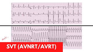 SVT AVRT AVNRT  For DO MD NP PA Part 3 [upl. by Beasley24]