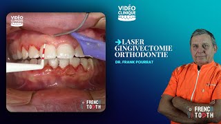 Laser gingivectomie orthodontie  Dr Pourrat [upl. by Rutra]