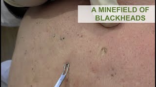 A Minefield of Blackheads  Dr Derm [upl. by Valdis]