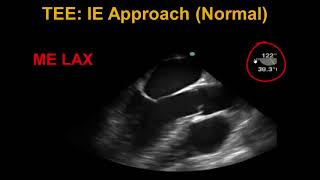 Transesophageal Echocardiography Infective Endocarditis [upl. by Willyt]