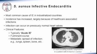 Endocarditis Microbiology and Treatment [upl. by Esiom]