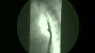 Video 8  Gastroesophageal reflux [upl. by Jamille465]