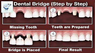 Dental Bridge Procedure Step by Step [upl. by Rhetta]