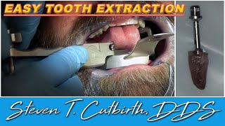 Easy Tooth Extraction  Dental Minute with Steven T Cutbirth DDS [upl. by Sarajane]