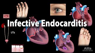 Infective Endocarditis Animation [upl. by Kara-Lynn]