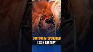 ContouraTopoguided Lasik surgery [upl. by Ethelind]