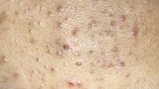 AWESOME POPPING BLACKHEADS FIELD  Suri Job 130 [upl. by Manno]