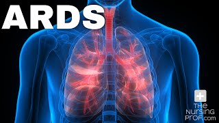 Acute Respiratory Distress Syndrome ARDS [upl. by Doy536]