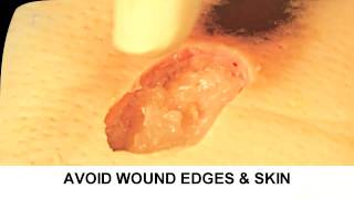 Enzymatic Debridement Demonstration Understand Wound Care [upl. by Ielarol188]