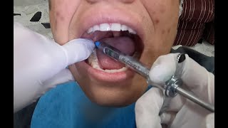 Tecnica de anestesia Dentario inferior y Mentoniano [upl. by Derfliw]