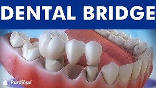 Dental bridge  Fixed dental replacement © [upl. by Noyk]