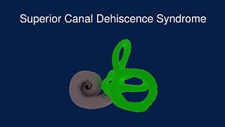 Superior Canal Dehiscence Syndrome SCDS [upl. by Rednasxela939]