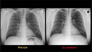 Pineal Region Tumors RadiologicPathologic Correlation [upl. by Eekaz]